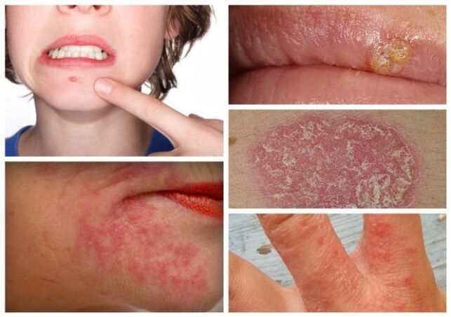 As alerxias e enfermidades da pel son sinais de parasitos no corpo
